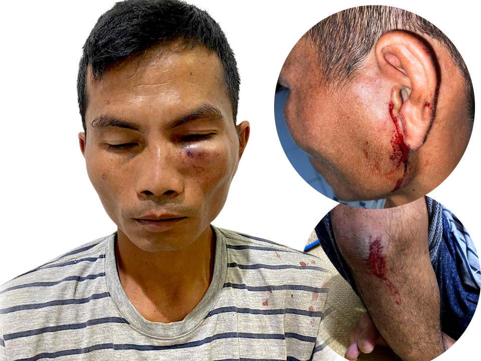 Emosi Tak diberi Rokok, Seorang  Warga distabilitas Di Desa Lamamek Jadi Korban Kekerasan Brutal